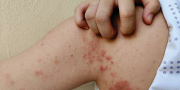 Piauí está entre os estados com maior taxa de detecção de hanseníase no país