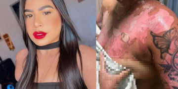 Mulher internada após ataque com óleo quente pede ajuda para sustentar filho e custear despesas em Teresina