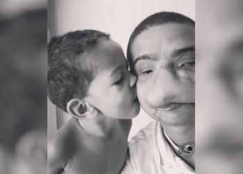 Jovem que perdeu parte do rosto ao ser atingido por fogos bomba na web ao contar sua história
