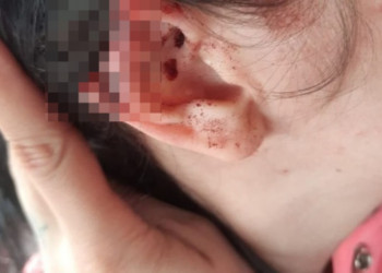 Homem é preso após arrancar pedaço de orelha da namorada com mordida