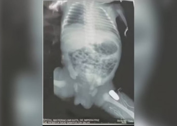 Adolescente realiza parto de emergência após ser baleada; projétil ficou alojado na perna de bebê