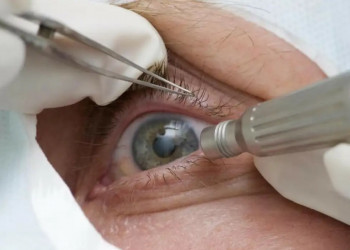 Cirurgia que altera cor do olho tem uso restrito para pessoas cegas