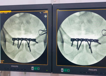 Hospital de Piripiri realiza, pela primeira vez, cirurgia ortopédica de alta complexidade em paciente com fratura de bacia