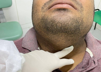 FMS alerta para sinais de câncer bucal e reorganiza atendimento em Teresina