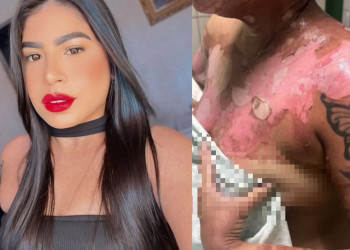 Mulher internada após ataque com óleo quente pede ajuda para sustentar filho e custear despesas em Teresina