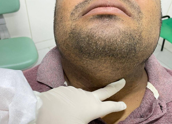 FMS alerta para sinais de câncer bucal e reorganiza atendimento em Teresina