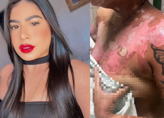 Mulher internada após ataque com óleo quente pede ajuda para sustentar filho e custear despesas em Teresina
