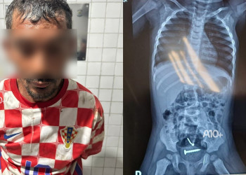 Homem é preso por estuprar mulher e filha no Piauí; médicos encontraram objetos no corpo da bebê