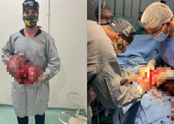 Equipe médica retira tumores de quase 11kg de paciente idosa em Floriano