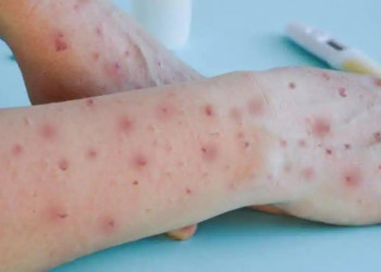 Como saber se já tomei vacina de varíola? Ela funciona contra o vírus monkeypox?