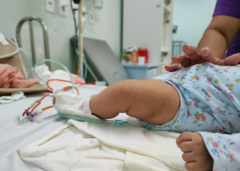 Casos de Síndrome Respiratória Aguda Grave aumentam em crianças e Hospital Infantil faz alerta