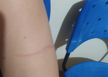 Mulher é atacada pelo ex-companheiro com faca no interior do Piauí
