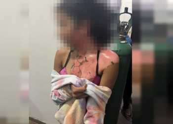 Tia joga água quente na própria sobrinha de 14 anos por ciúmes do marido